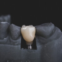 wszczepienie implantu zęba